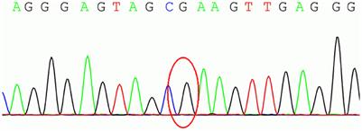 A homozygous PRKN-associated juvenile Parkinson's disease with pregnancy in China